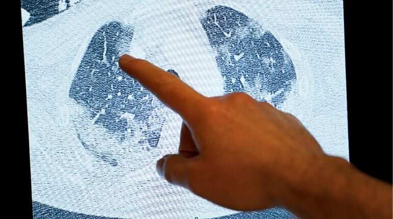 A doctor shows on screen the scan of the lungs of a patient infected by the COVID-19, at the "middle care" unit for COVID-19 infected patients at the Erasme Hospital in Brussels, on April 30, 2020 during a lockdown in the country to stop the spread of the novel coronavirus.
