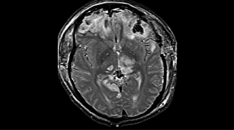 Cuba 'incidents' caused brain injury, nerve damage to diplomats