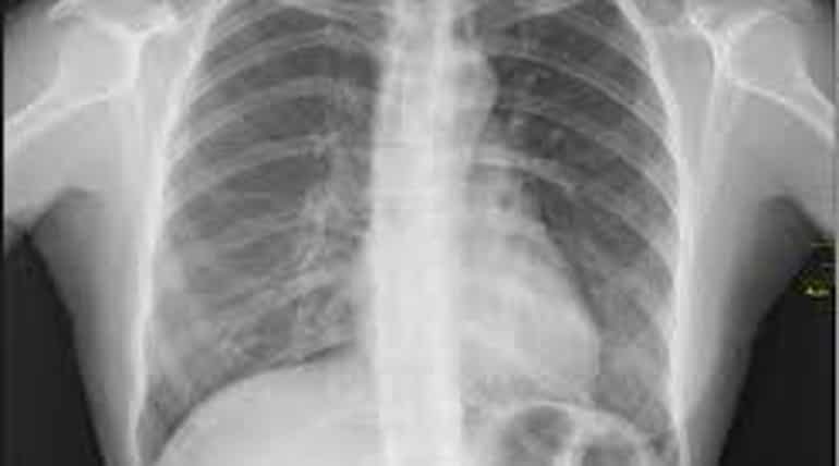 International X-Ray day: How Rontgen discovered the 'unknown' rays International X-Ray day: How Rontgen discovered the 'unknown' rays