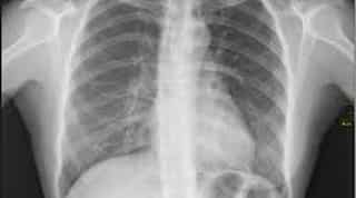 International X-Ray day: How Rontgen discovered the 'unknown' rays