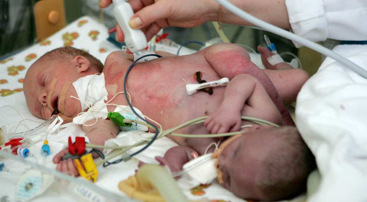 Woman gives birth to Siamese twins in Maharashtra