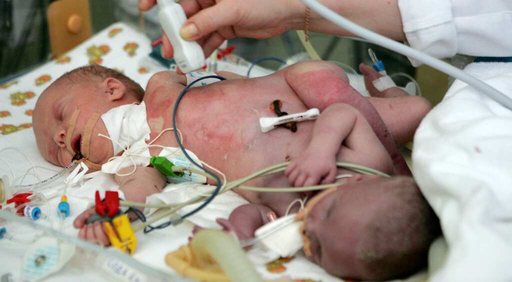 Woman gives birth to Siamese twins in Maharashtra