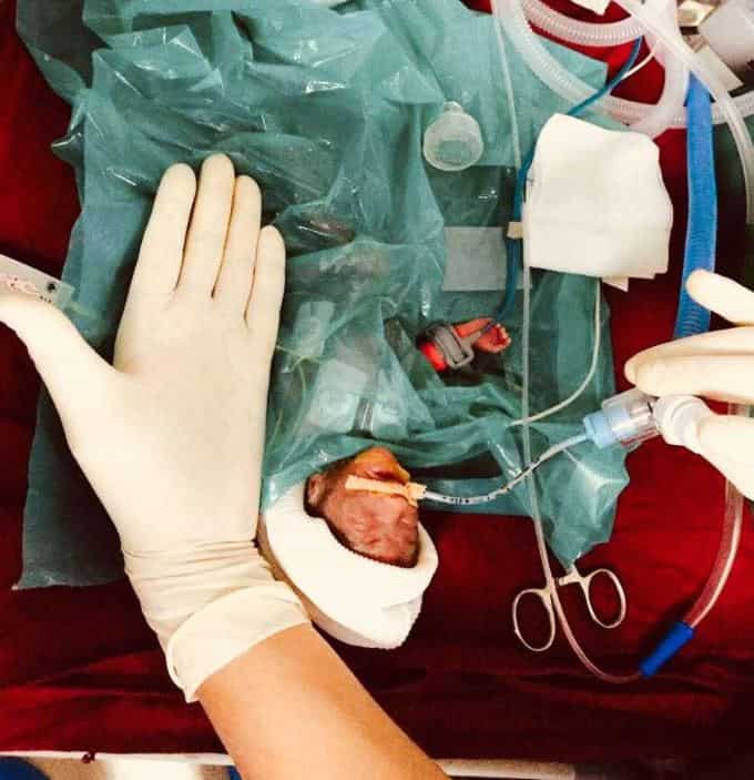 India's smallest baby, weighing only 375 grams, is born