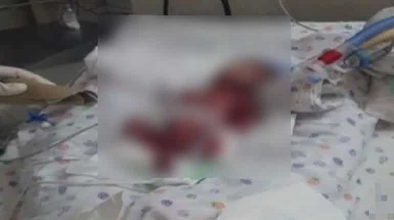 Delhi: Newborn, declared dead by hospital, found alive later Delhi: Newborn, declared dead by hospital, found alive later