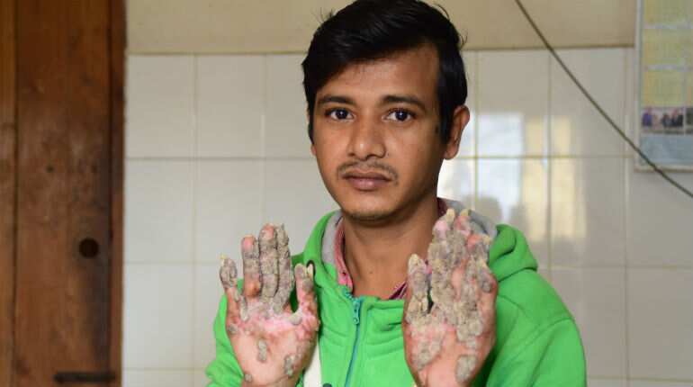 After 24 surgeries, Bangladesh 'tree man' relapses After 24 surgeries, Bangladesh 'tree man' relapses