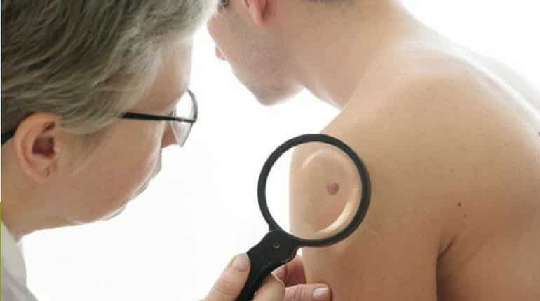 Melanoma skin cancer numbers reach record high in UK, shows study