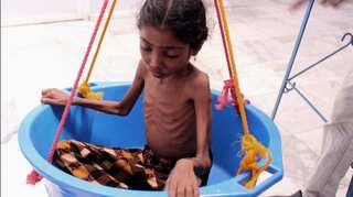 Yemen's infants face starvation as war rages on