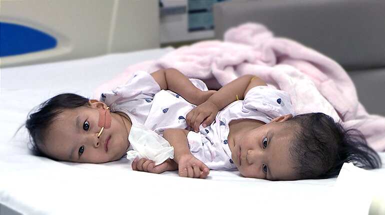 Bhutanese conjoined twins separated at Australian hospital Bhutanese conjoined twins separated at Australian hospital