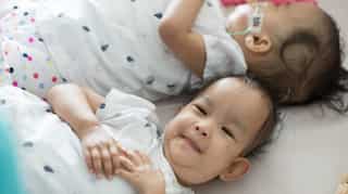Bhutanese twins in stable condition after surgery in Australia
