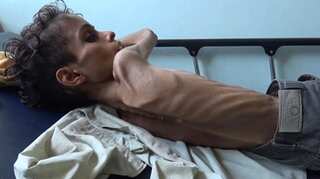War in Yemen: 10-year-old boy weighs 8 kilograms