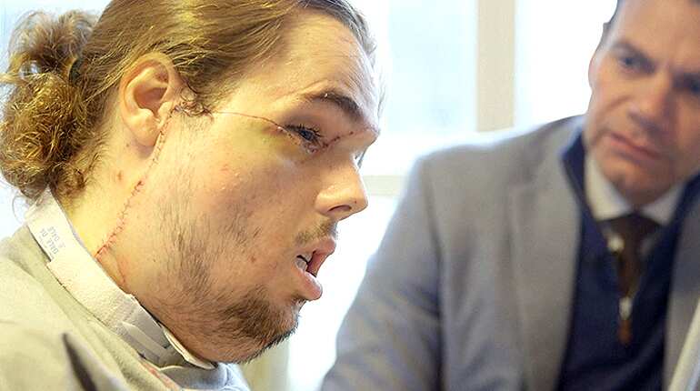 US face transplant patient reveals new face