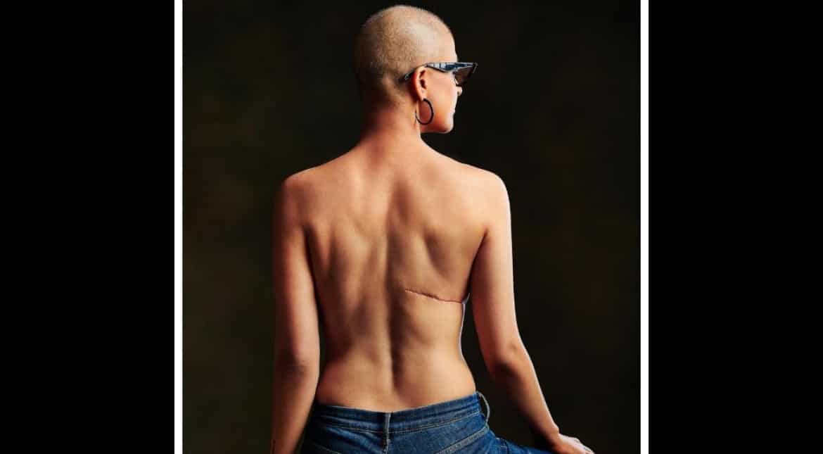 Tahira Kashyap poses topless as she flaunts her scars as badges of honour on World Cancer Day Tahira Kashyap poses topless as she flaunts her scars as badges of honour on World Cancer Day