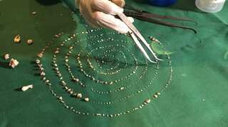 Chennai doctors pull 526 teeth from 7-year-old boy's mouth