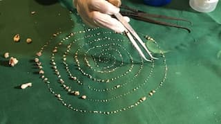Chennai doctors pull 526 teeth from 7-year-old boy's mouth