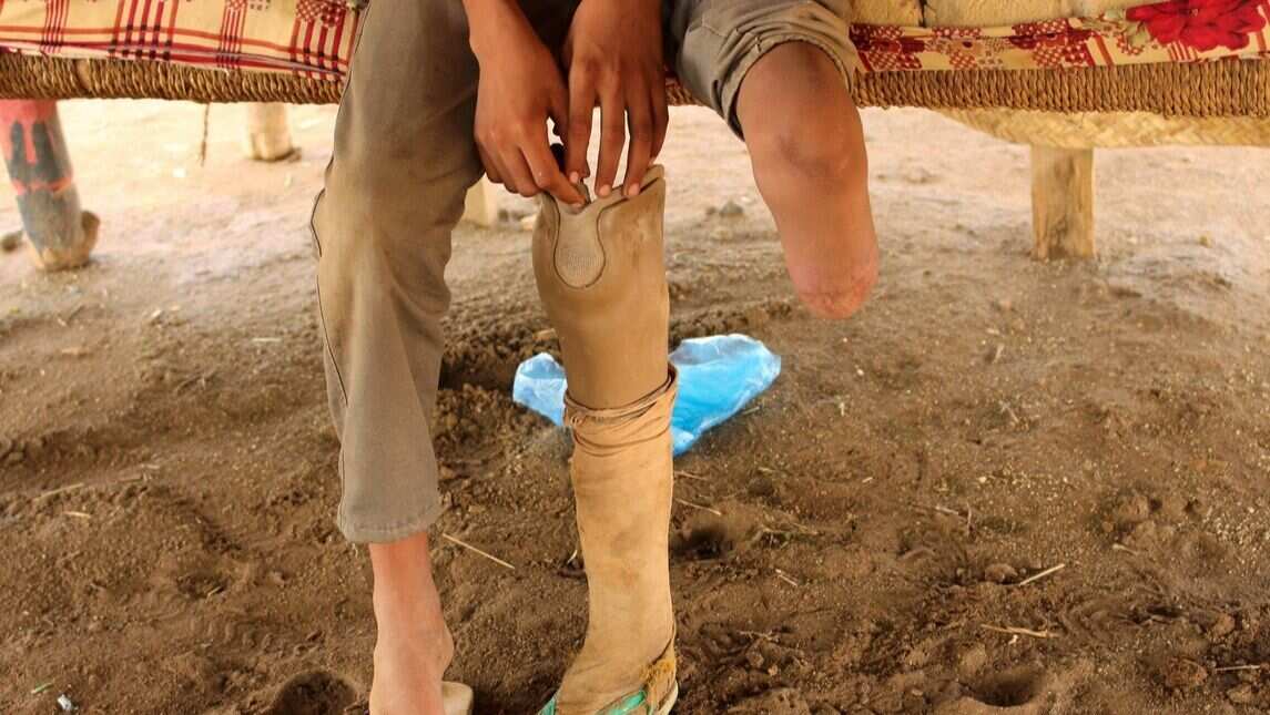 A boy who lost his leg in Air Strike