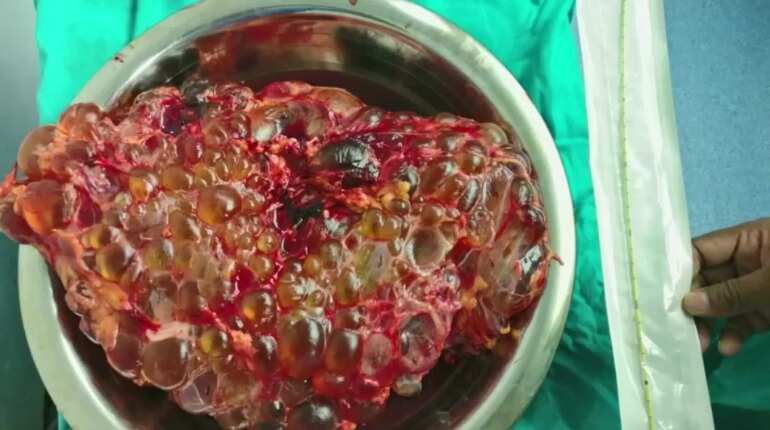 Doctors remove 7.5 kg kidney in a surgery in Delhi