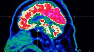 Coronavirus can lead to brain impairment, say neurologists