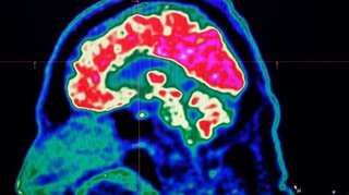 Parkinson's disease may up schizophrenia risk: Study