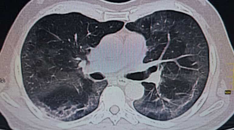 COVID-19 may cause long-term lung damage: Study