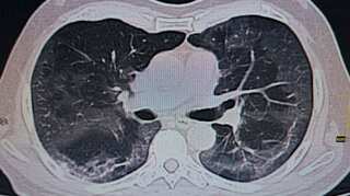 COVID-19 may cause long-term lung damage: Study