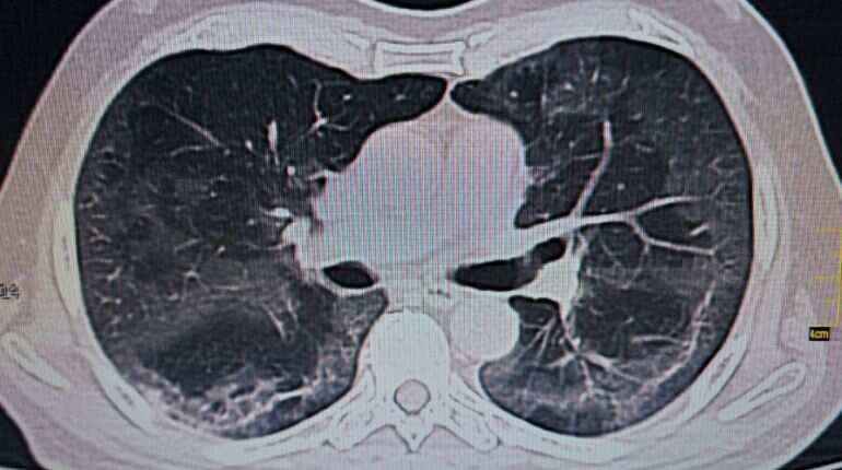 Abnormalities spotted in lungs of 60% coronavirus patients months later: Oxford University study