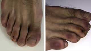 Covid toes: Scientists discover red and swollen feet as new symptom