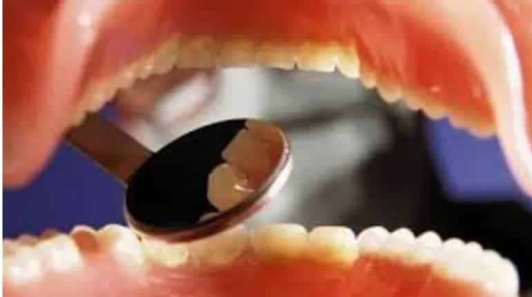 Oral ulcer, teeth cracking may be symptoms of coronavirus: UK professor