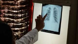 New tuberculosis treatment to cut pill intake significantly