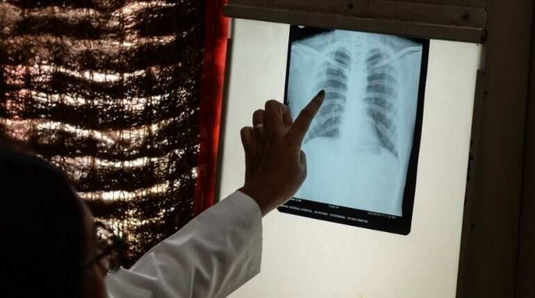 New tuberculosis treatment to cut pill intake significantly