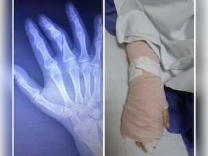 COVID-19 in Iran: Gaurd breaks female journalist's finger for not deleting interviews