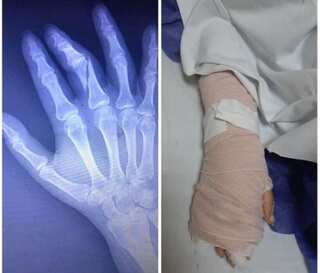COVID-19 in Iran: Gaurd breaks female journalist's finger for not deleting interviews