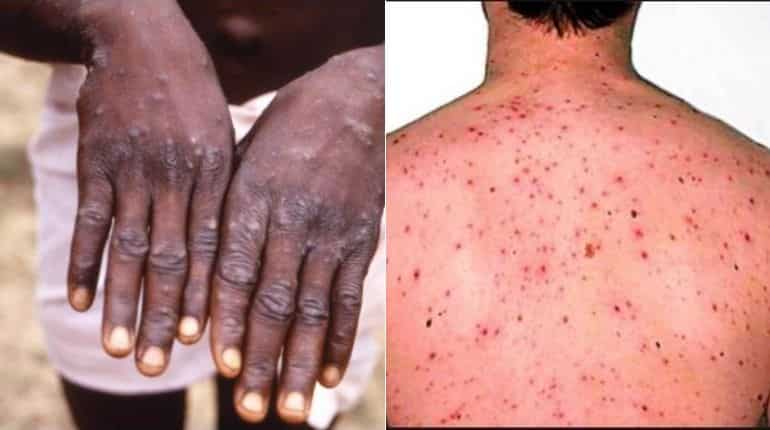 Monkeypox outbreak in the UK: Two treated for rare viral infection in North Wales Monkeypox outbreak in the UK: Two treated for rare viral infection in North Wales