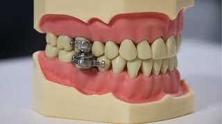 Keep your jaw shut: New Zealand researchers' new 'weight loss' device labelled as 'torture'
