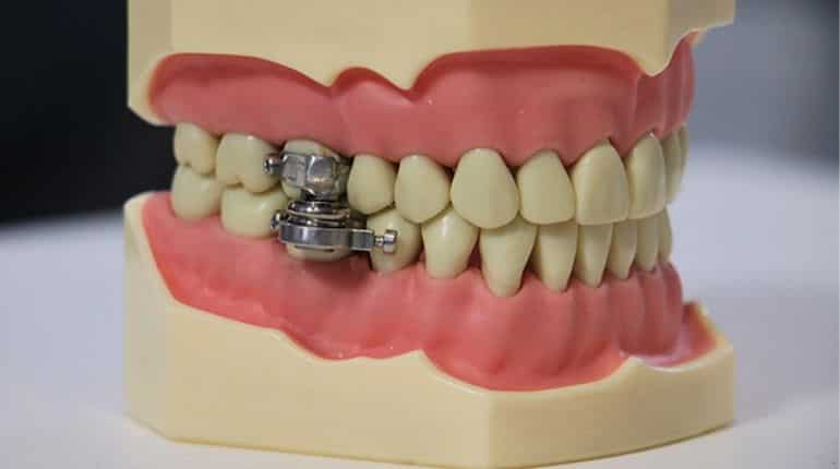 Keep your jaw shut: New Zealand researchers' new 'weight loss' device labelled as 'torture'