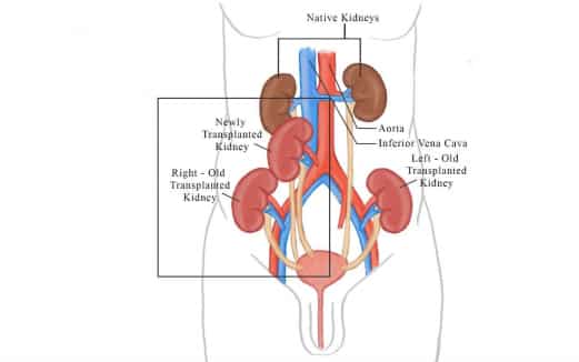 Bangladeshi patient undergoes successful 3rd transplant in India; healthy with 5 kidneys Bangladeshi patient undergoes successful 3rd transplant in India; healthy with 5 kidneys