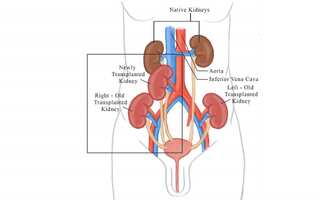 Bangladeshi patient undergoes successful 3rd transplant in India; healthy with 5 kidneys