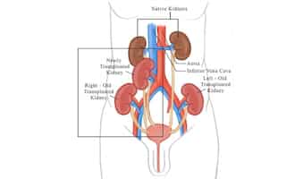 Bangladeshi patient undergoes successful 3rd transplant in India; healthy with 5 kidneys