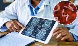 Tapeworms in brain reason behind man's altered mental status and unexplained seizures, study reveals