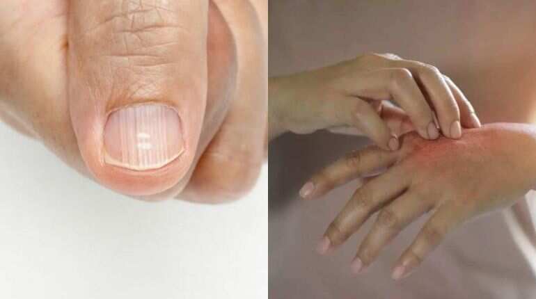Omicron: Skin, lips, and nail symptoms that mean you need urgent COVID-19 treatment
