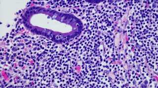 Metabolic vulnerability of Lymphoma cells can be used to trick these cancers into starving themselves: Study