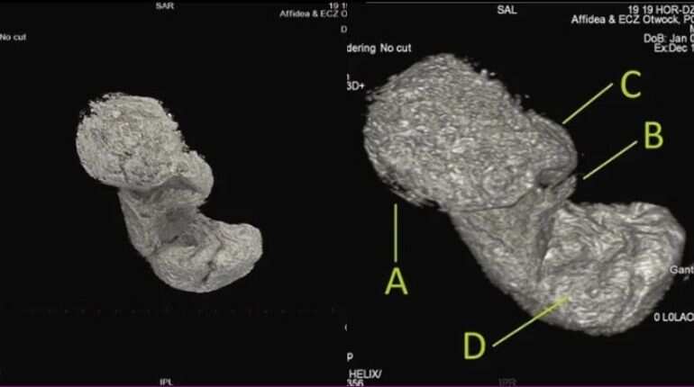 This 'pickled' fetus of an Egyptian mummy is baffling scientists