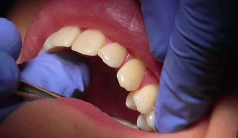 Indian scientists identify 114 genetic variants linked to oral cancer