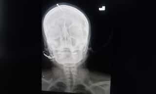 Pakistani pregnant woman gets nail hammered into head in the hope for a boy