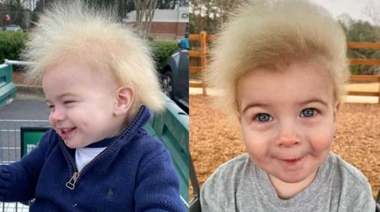 Locklan Samples: This boy suffering from 'uncombable hair syndrome' has water-resistant locks Locklan Samples: This boy suffering from 'uncombable hair syndrome' has water-resistant locks