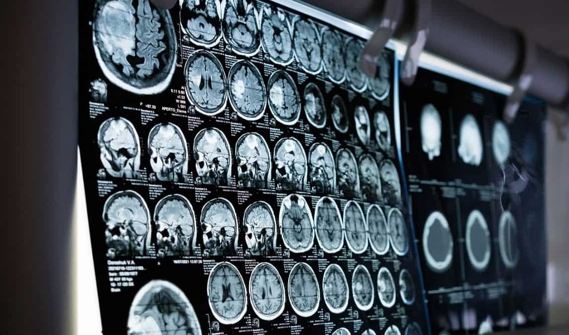 'I love my cool son': Brain implant helps fully paralysed man to spell out thoughts 'I love my cool son': Brain implant helps fully paralysed man to spell out thoughts