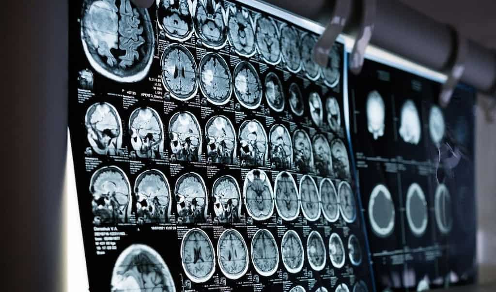 'I love my cool son': Brain implant helps fully paralysed man to spell out thoughts