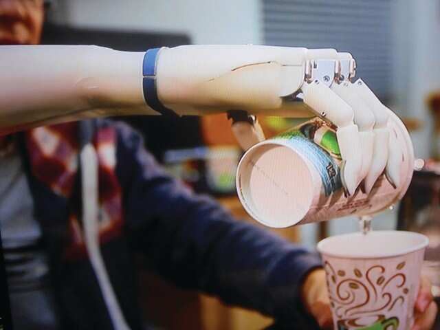 Low-cost bionic prosthetics arm equipped with sensors is transforming lives