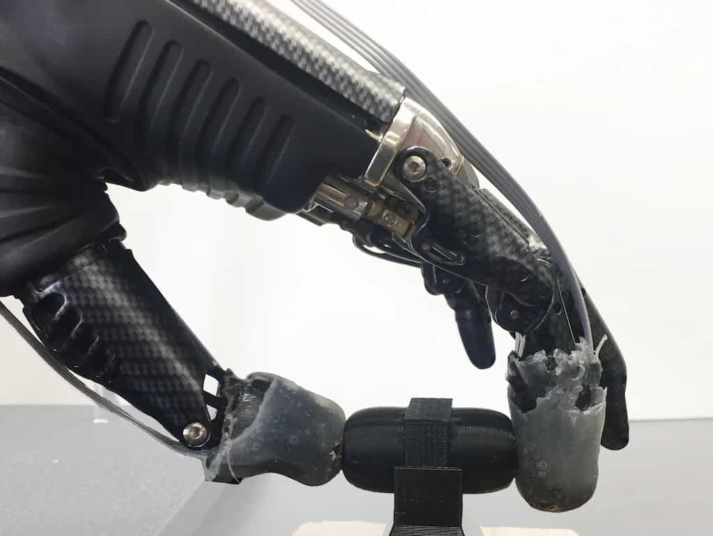 Low-cost Bionic arm transforms lives, helps attain basic mobility