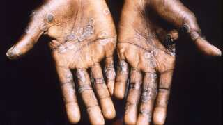 After US & Europe, monkeypox spreads to Israel