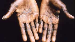 WHO to hold emergency meeting over rise in number of monkeypox cases   